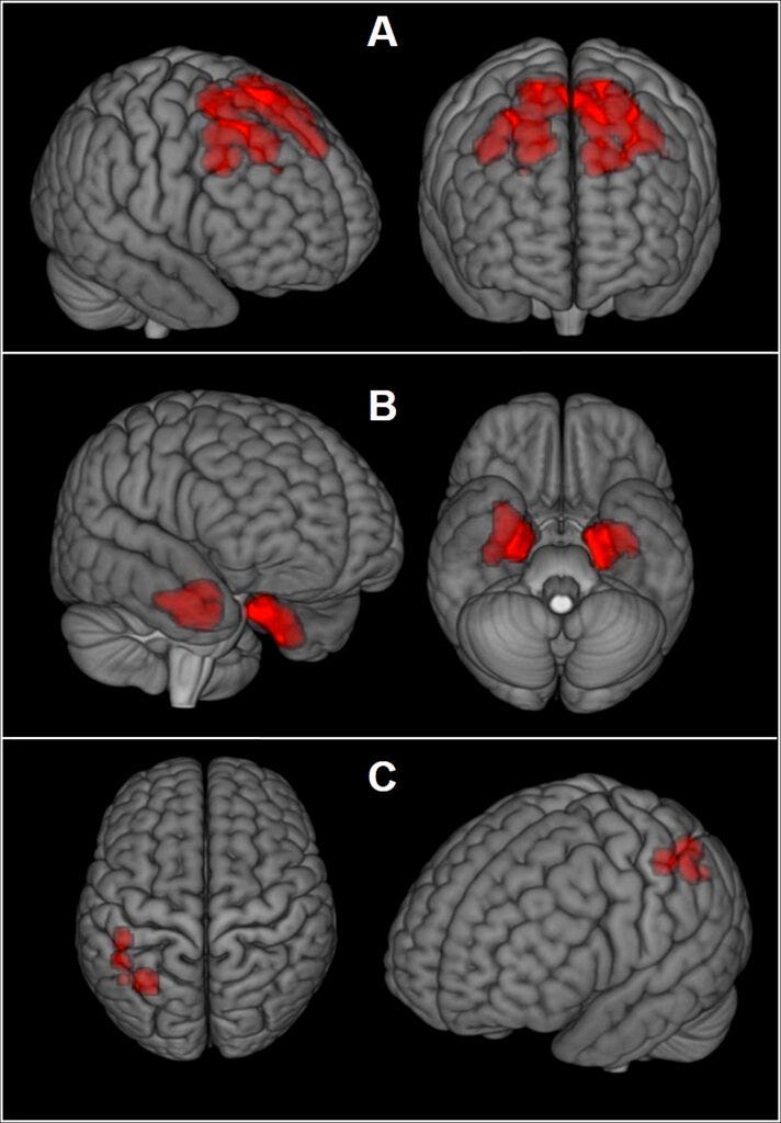 This image provided by The New England Journal of Medicine in April 2019 shows an illustration based on brain scans from former NFL players.
