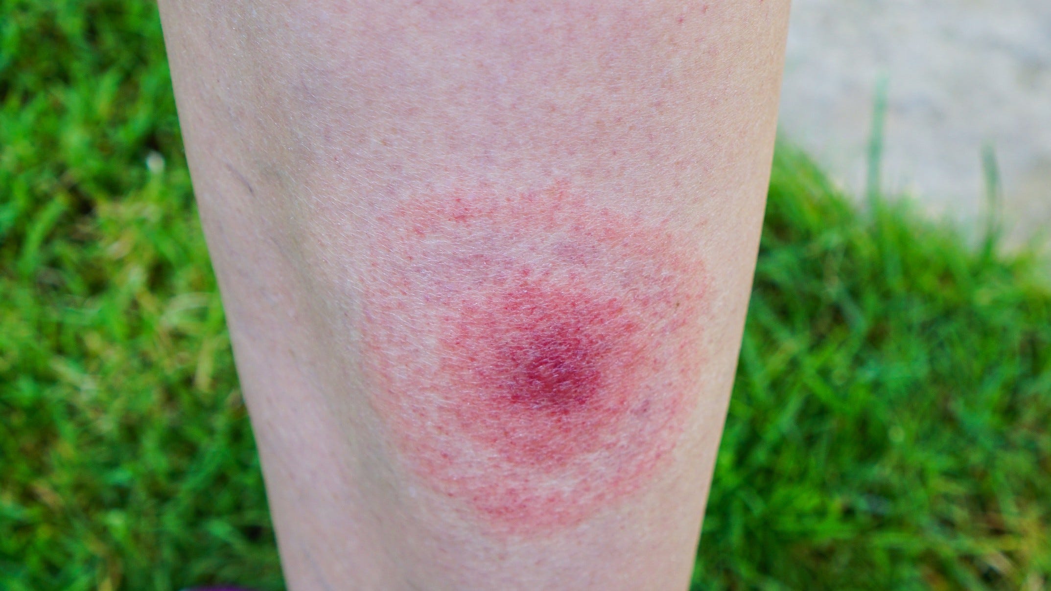 Medical Report: It’s the time of year to watch for Lyme disease symptoms