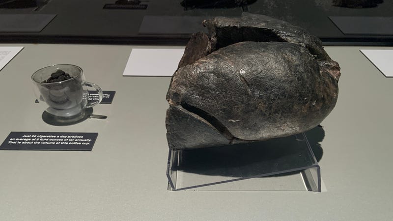 Smoker's lungs