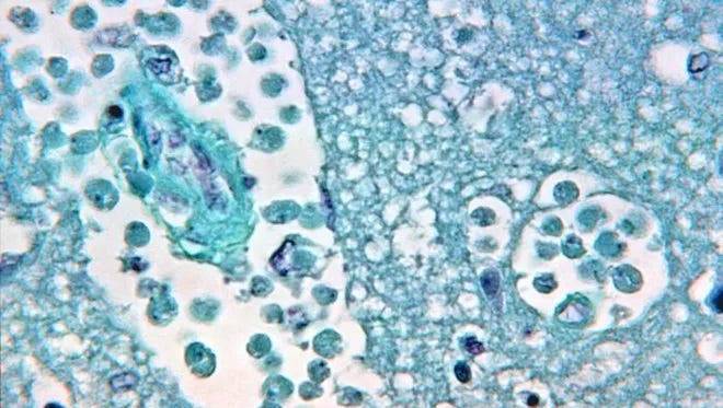 Brain-eating amoeba