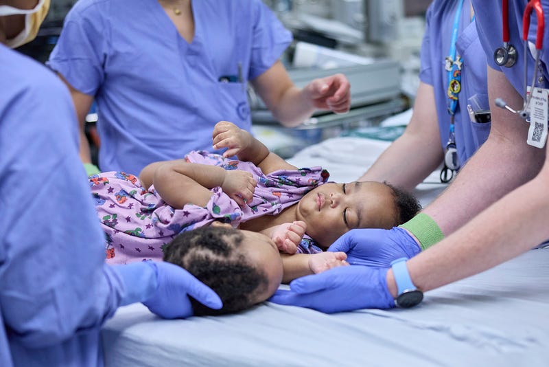 This photo provided by the Children’s Hospital of Philadelphia shows the hospital surgical team separating conjoined twins, Amari and Javar Ruffin, at the Children’s Hospital of Philadelphia, Aug. 21, 2024.