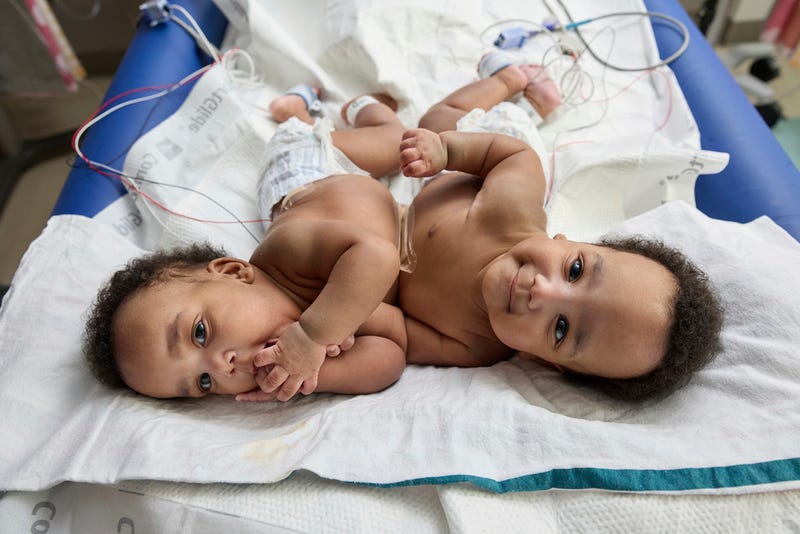 This photo provided by the Children’s Hospital of Philadelphia shows conjoined twins, Amari and Javar Ruffin, at the Children’s Hospital of Philadelphia, March 20, 2024.