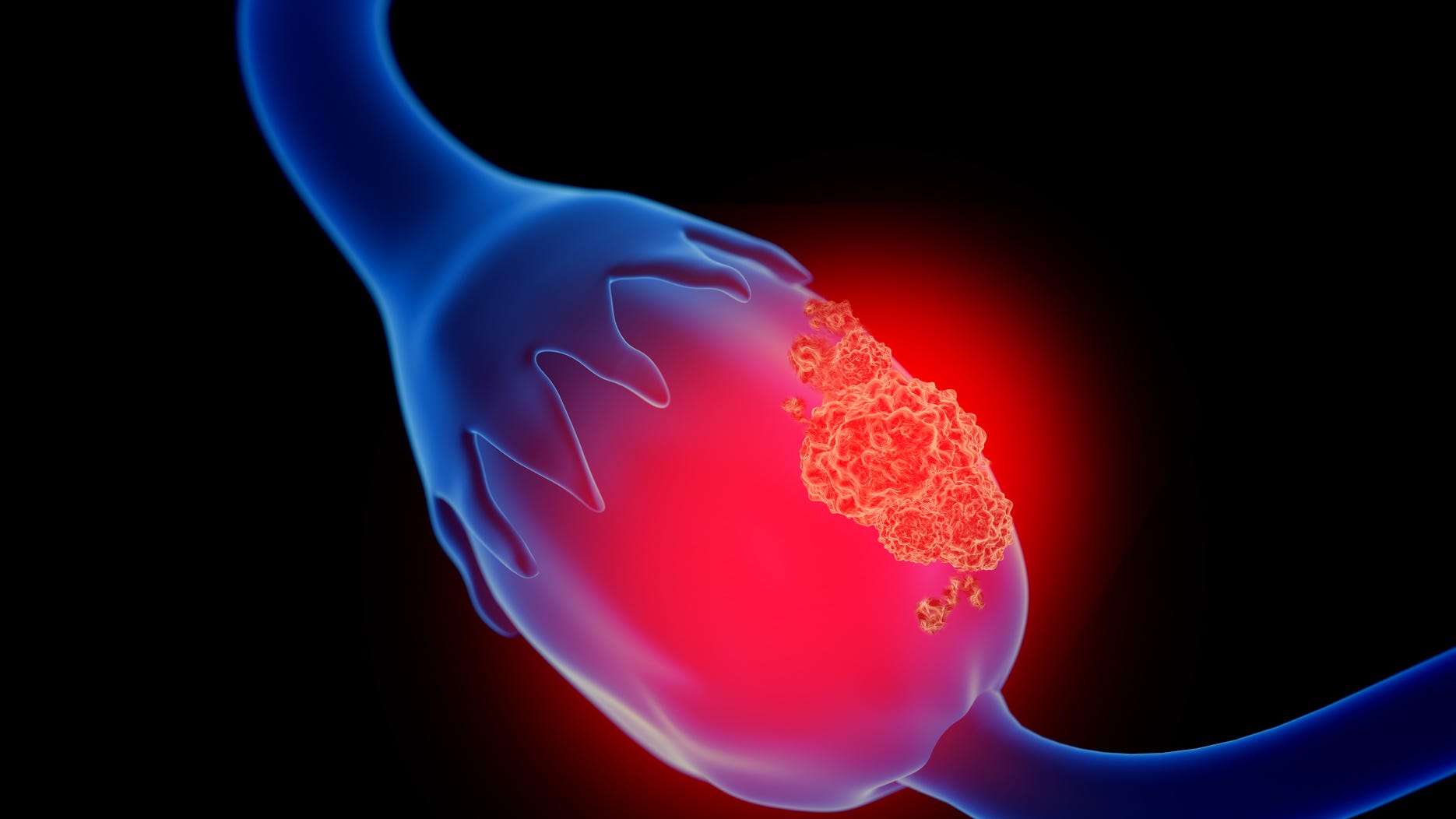 KYW Medical Report: The vague warning signs of ovarian cancer