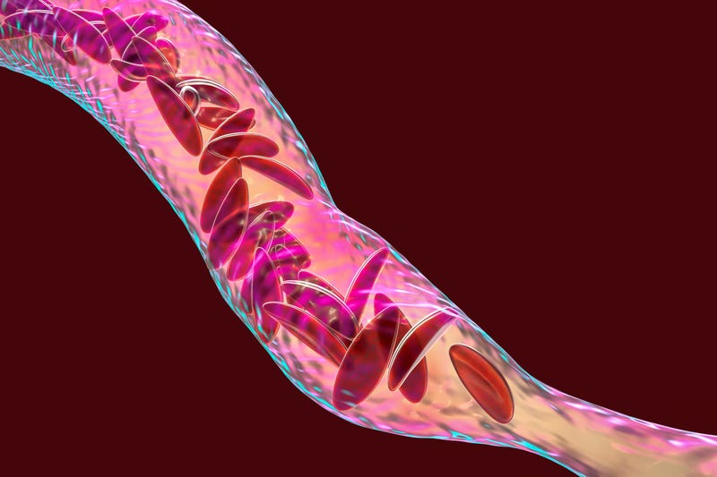 Sickle Cell Disease