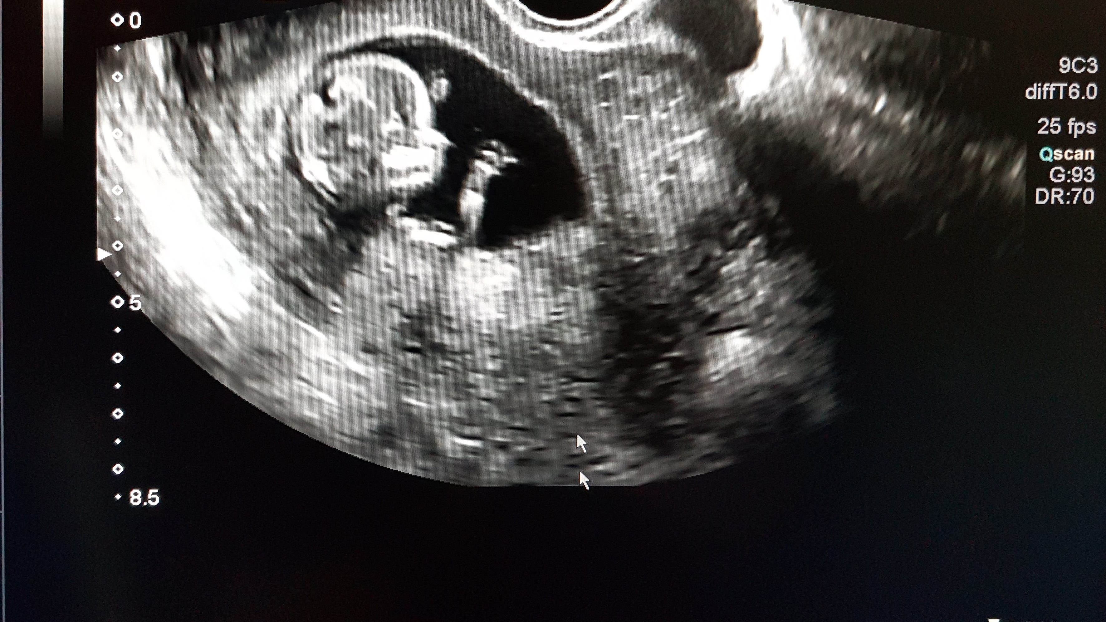 L.A. couple sues fertility clinic over baby mix up