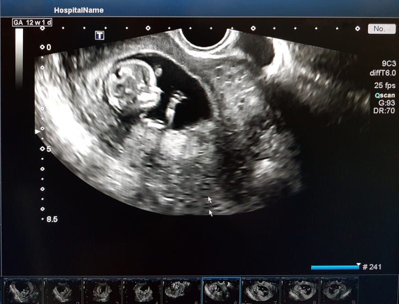 Ultrasound