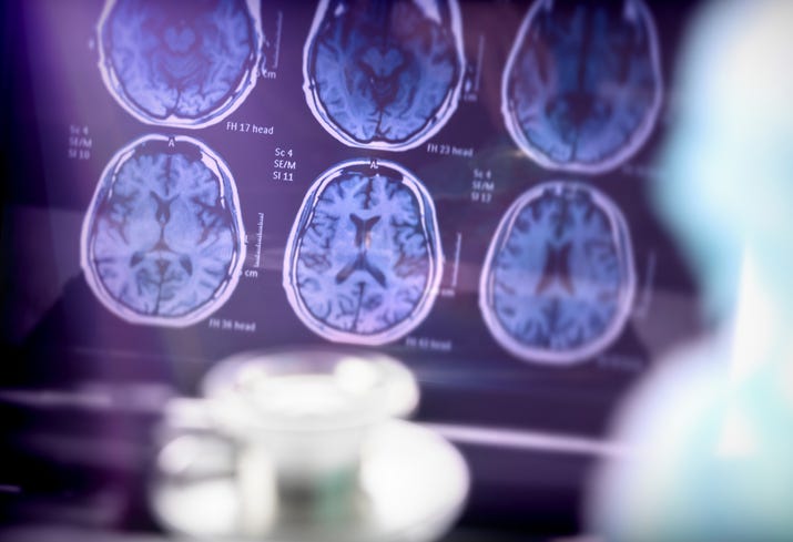 Scientific analysis of Alzheimer's disease in hospital