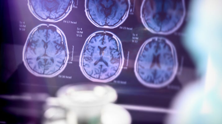 Was Alzheimer's research set back by doctored information in a 'groundbreaking' study?