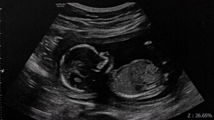 Family sues hospital for using wrong sperm donor for their now 30-year-old daughter