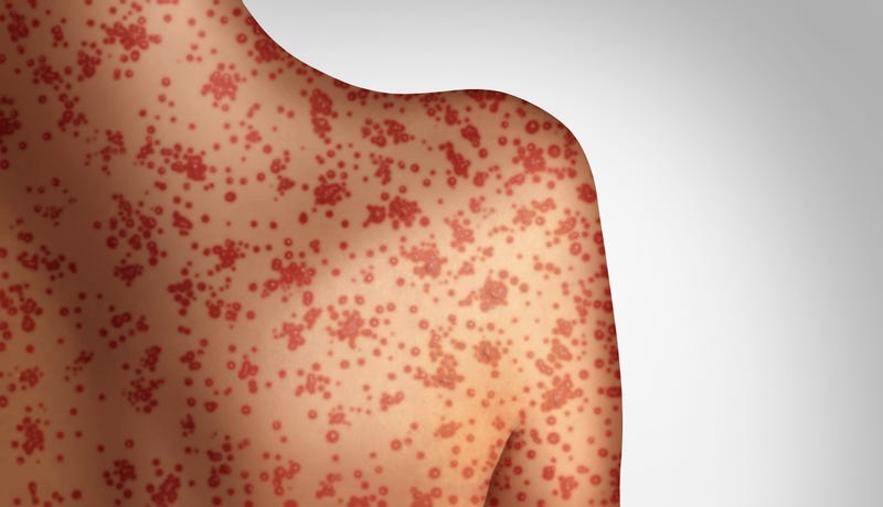 measles