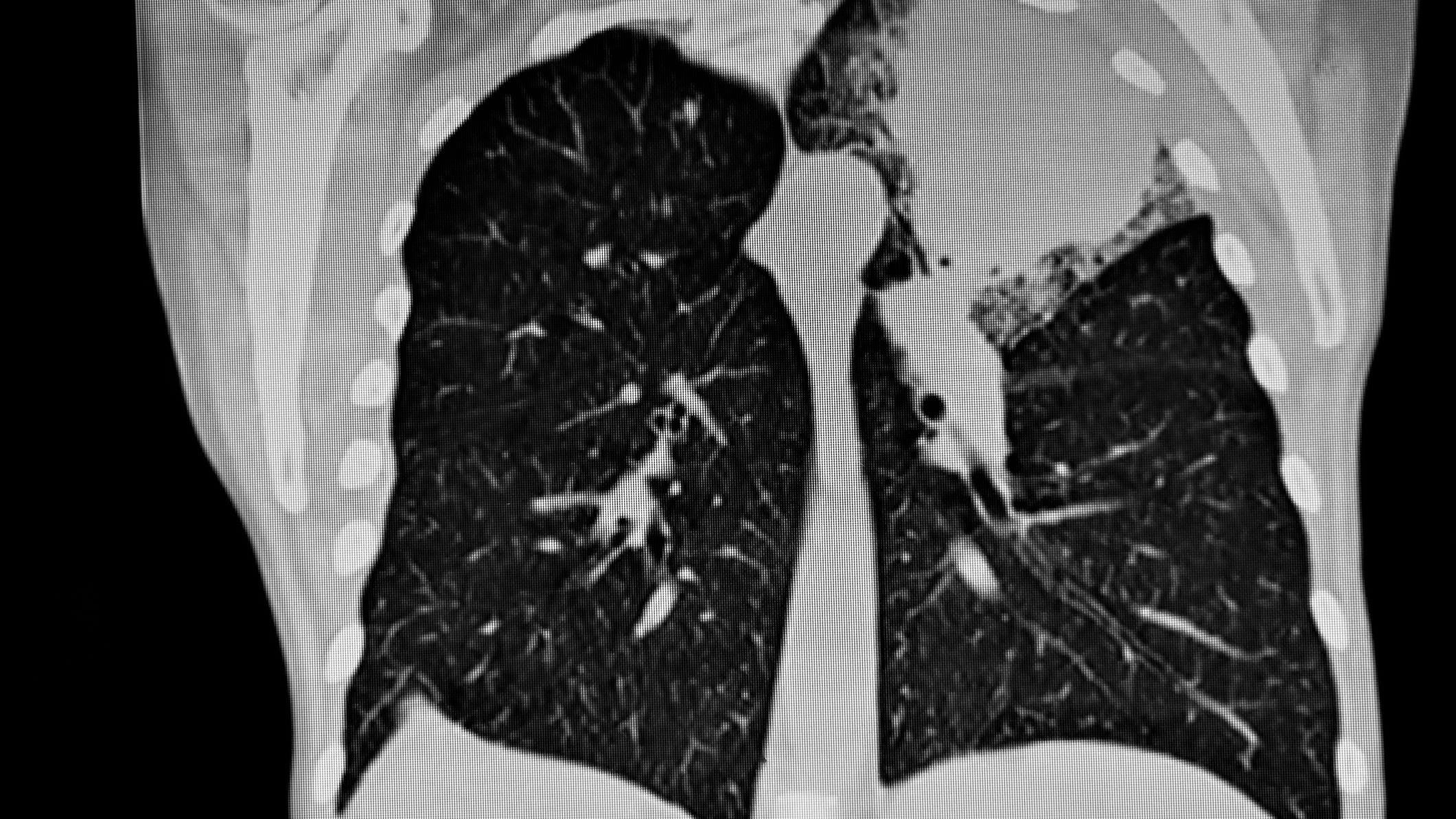 World Lung Cancer Day: a call to action
