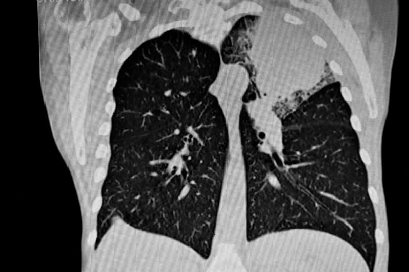 FILE: CAT scan of a lung tumor.