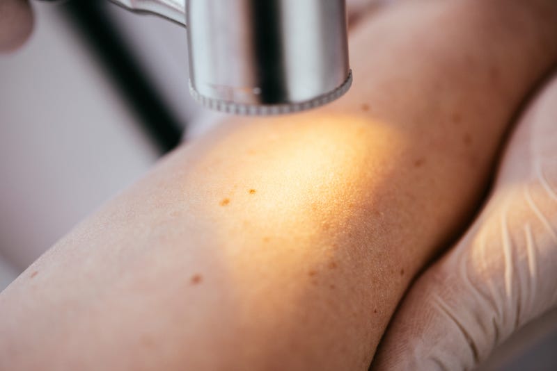 A free skin cancer screening in Wichita