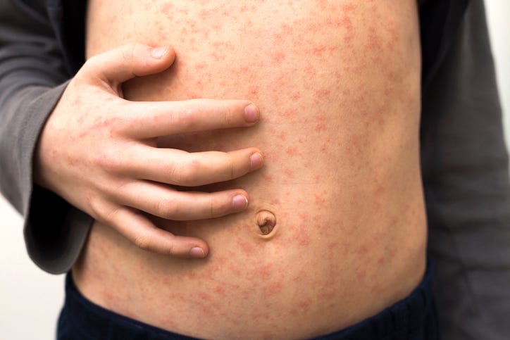 measles