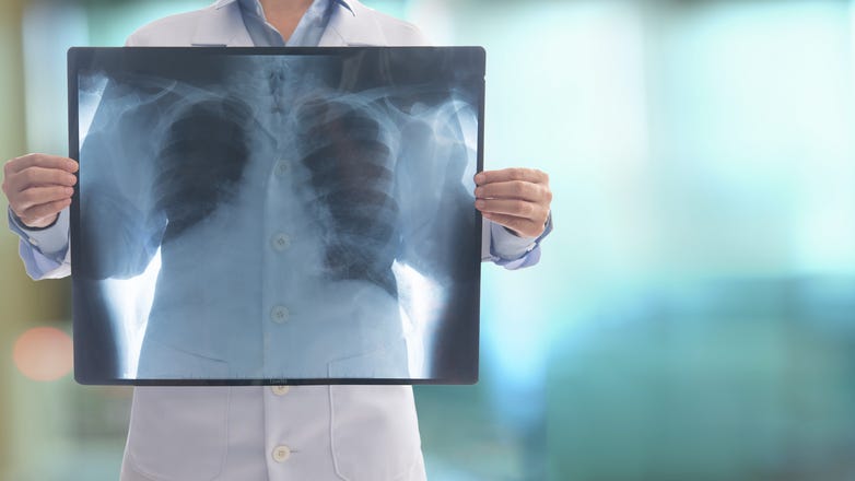 Scientists Seeing Lung Damage in Asymptomatic COVID-19 Patients