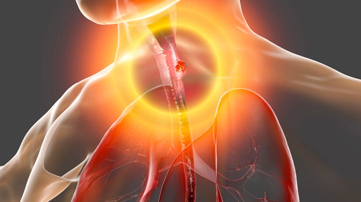Ask the Expert: Why is esophageal cancer so deadly?