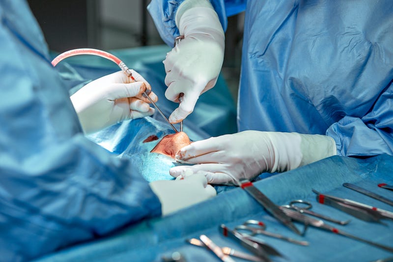 rhinoplasty