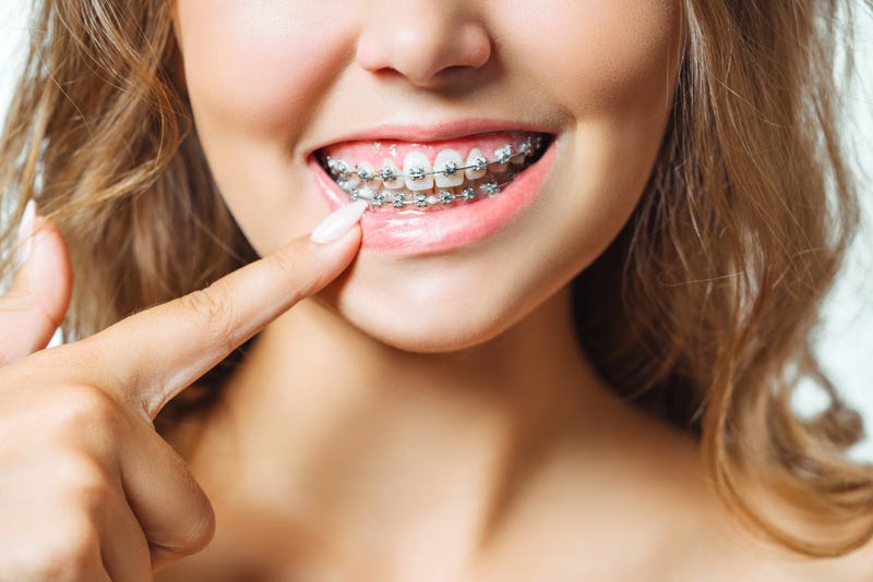 Person with braces stock photo.