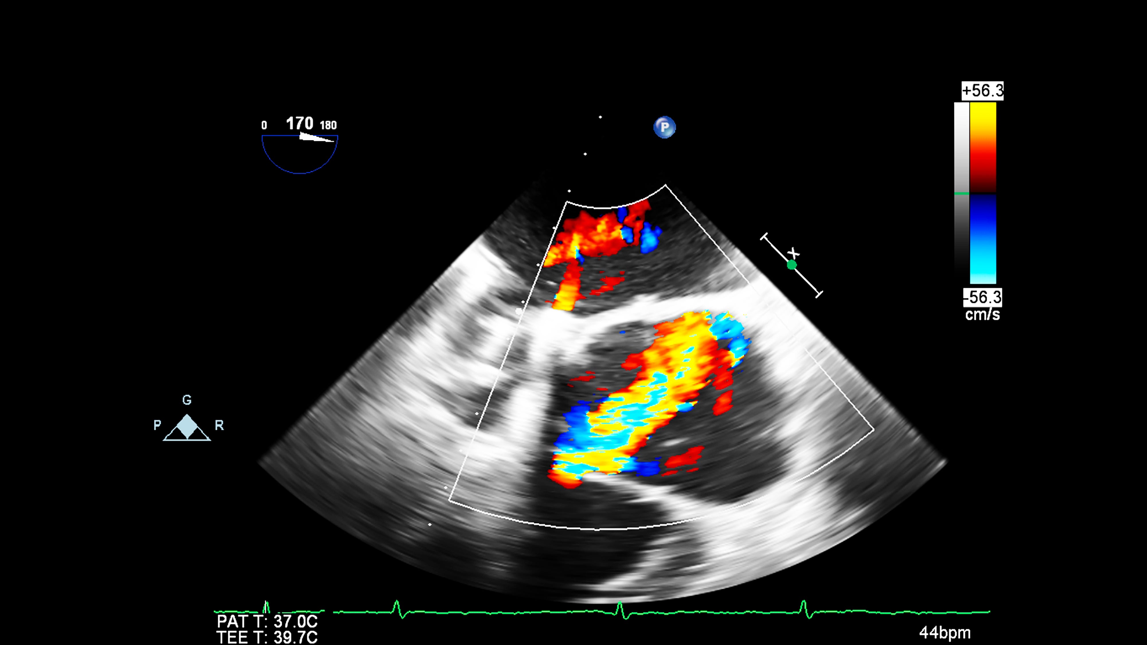Temple cardiologists develop virtual, less invasive way to diagnose pulmonary hypertension