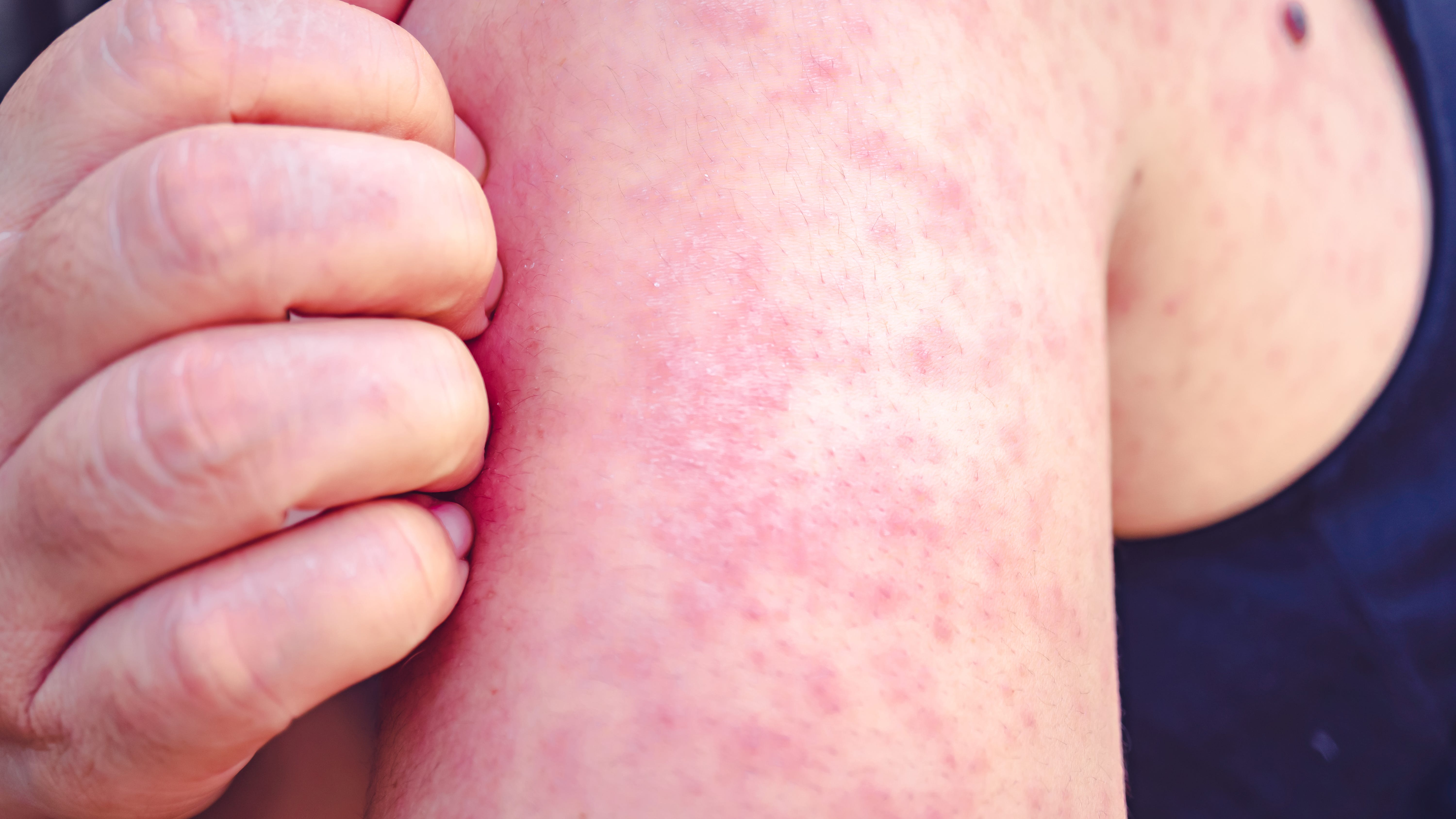 Measles case announced in Philadelphia