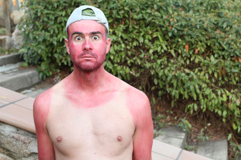 sunburn