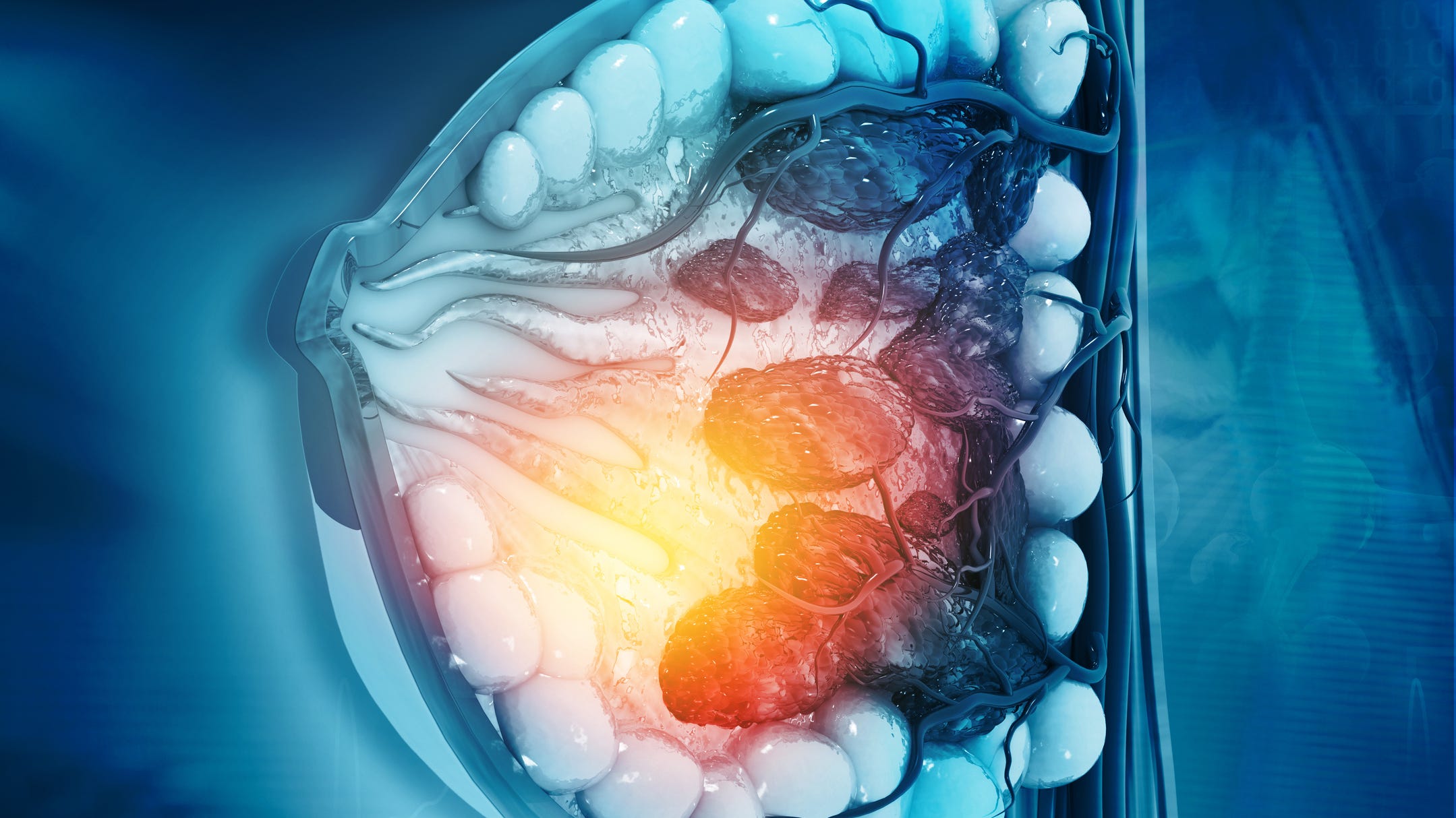 New breakthrough in detecting common breast cancer complication