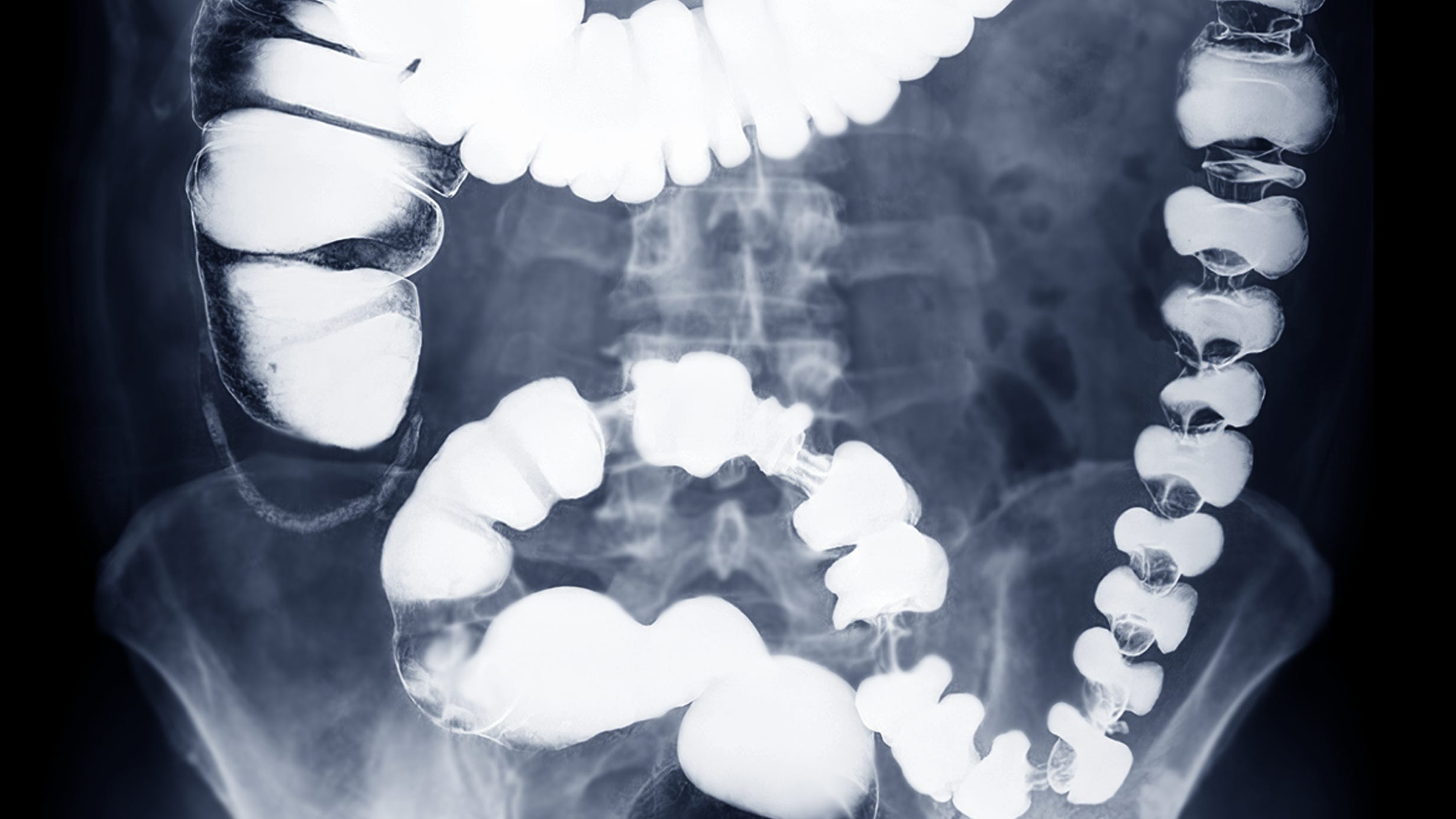 Loretto Hospital to offer free colon cancer screenings throughout March