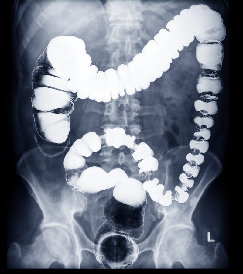 gastrointestinal (GI) screenings 