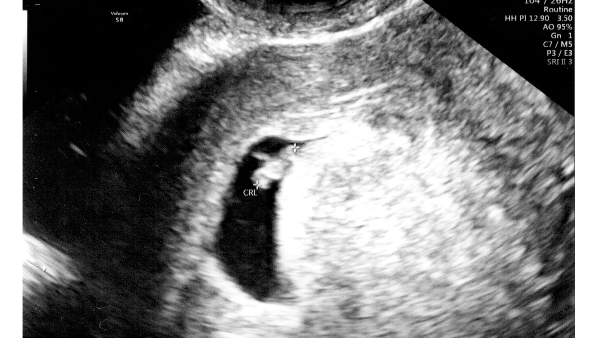 Florida proposes 6 week abortion ban