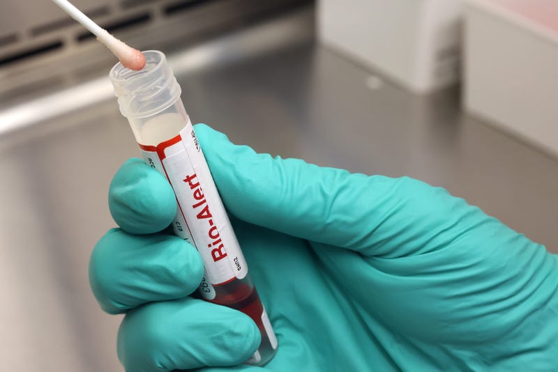 A swab that tested positive for the Monkeypox virus is seen at the UW Medicine Virology Laboratory at the UW Medicine Virology Laboratory on July 12, 2022 in Seattle, Washington. 