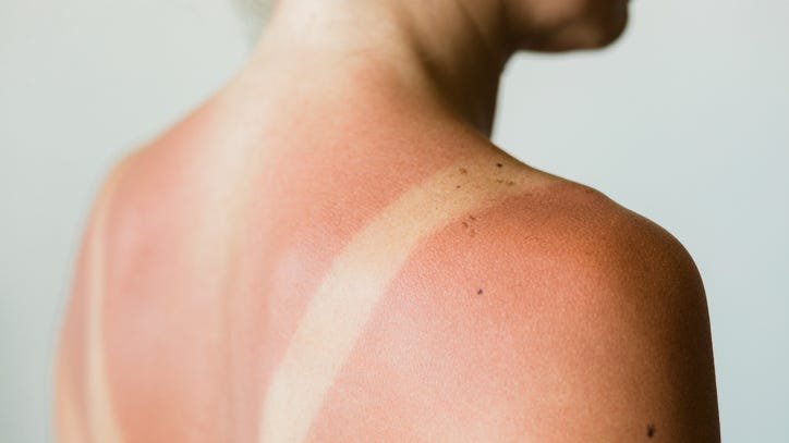 Researchers look to stop the negative effects of sunburn