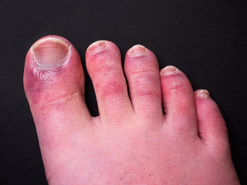A man's toes showing what looks like a rash with red blotchy skin. A common side effect of Covid-19 often referred to as "COVID toe."