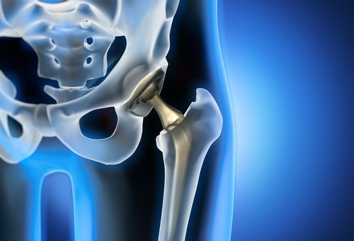 X-ray illustration of hip replacement