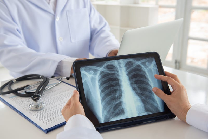 Lung Cancer