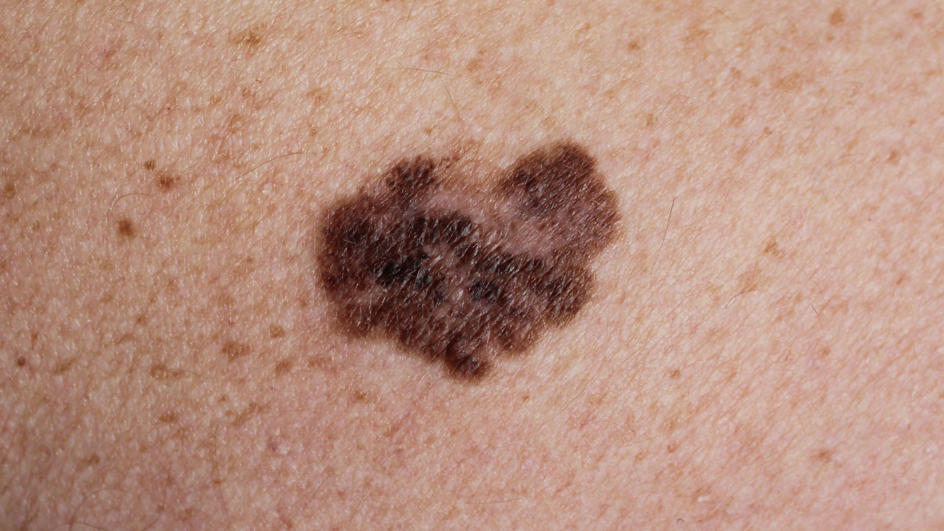 It's Melanoma Monday to emphasize prevention against the deadliest kind of skin cancer