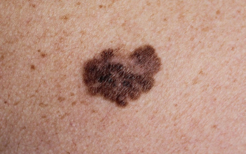 Skin mole