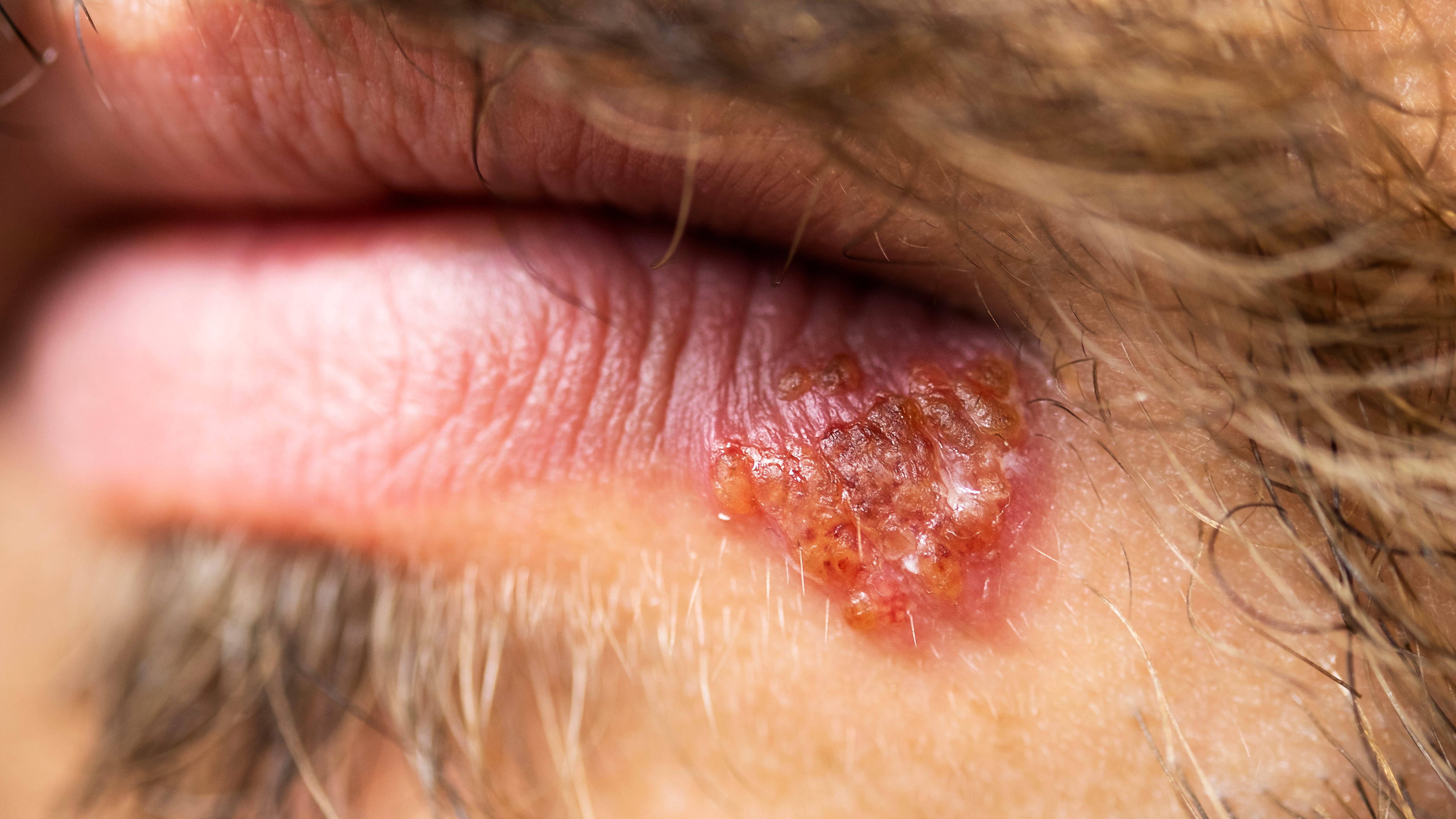 Northwestern University study examines how herpes moves in body, chances for vaccine