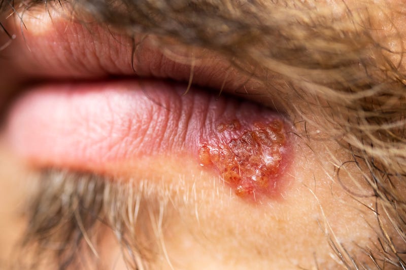 Northwestern University study figures out how herpes moves into the body’s nervous system 