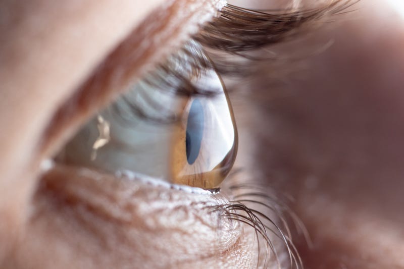 An eye with keratoconus, a condition where cornea tissue thins and bulges outward, leading to vision problems. 