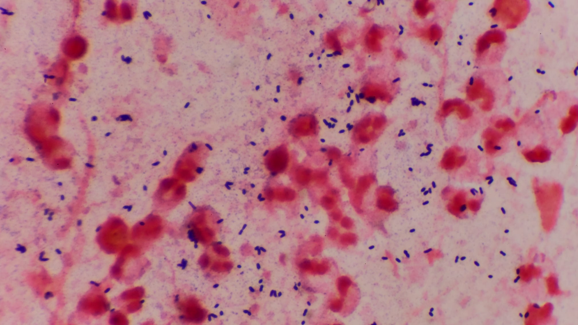 Legionnaires' disease bacteria found at San Jose hotel, guest nearly dies