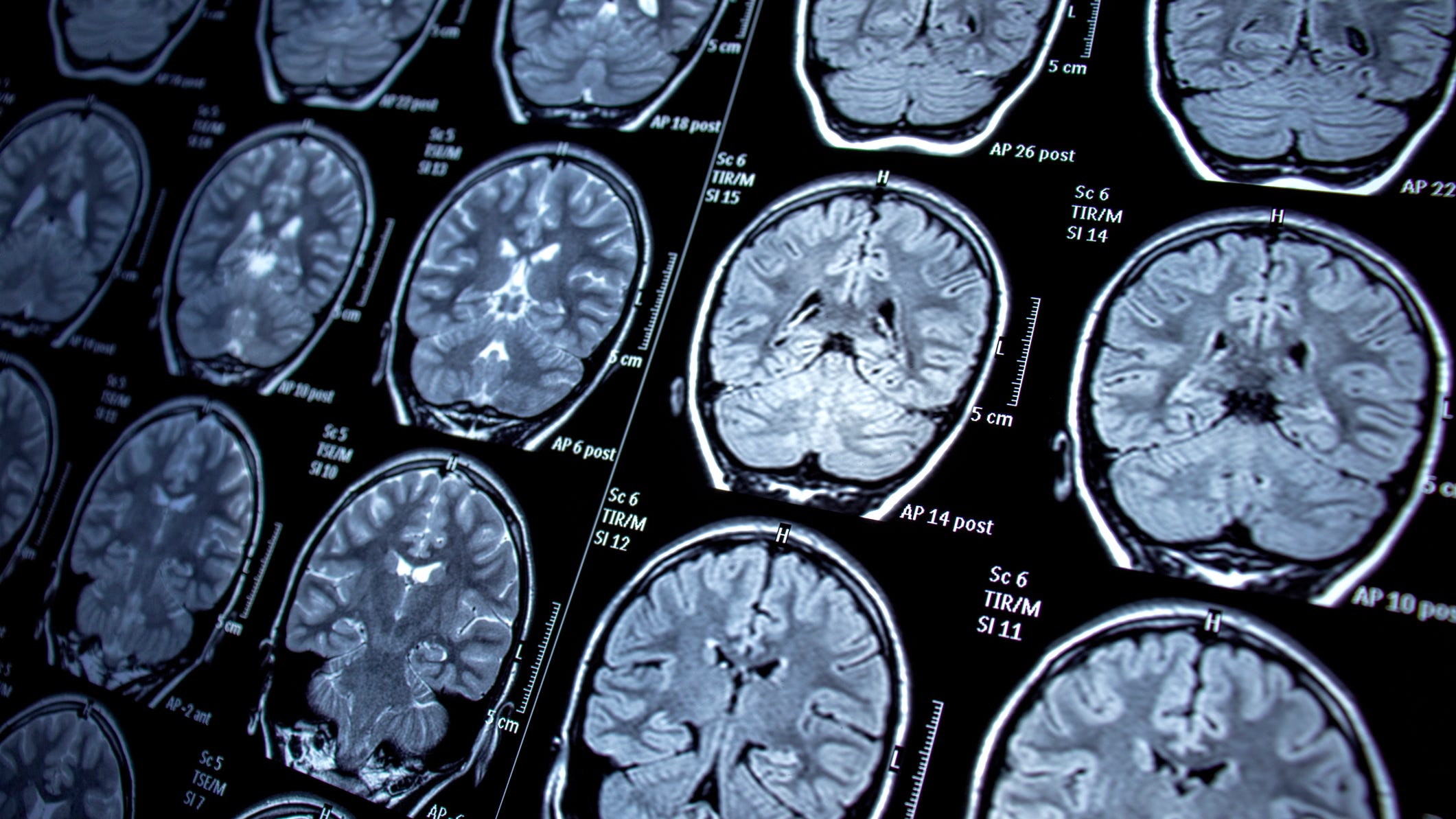 UCSF improves outcomes of brain tumors through aggressive surgery