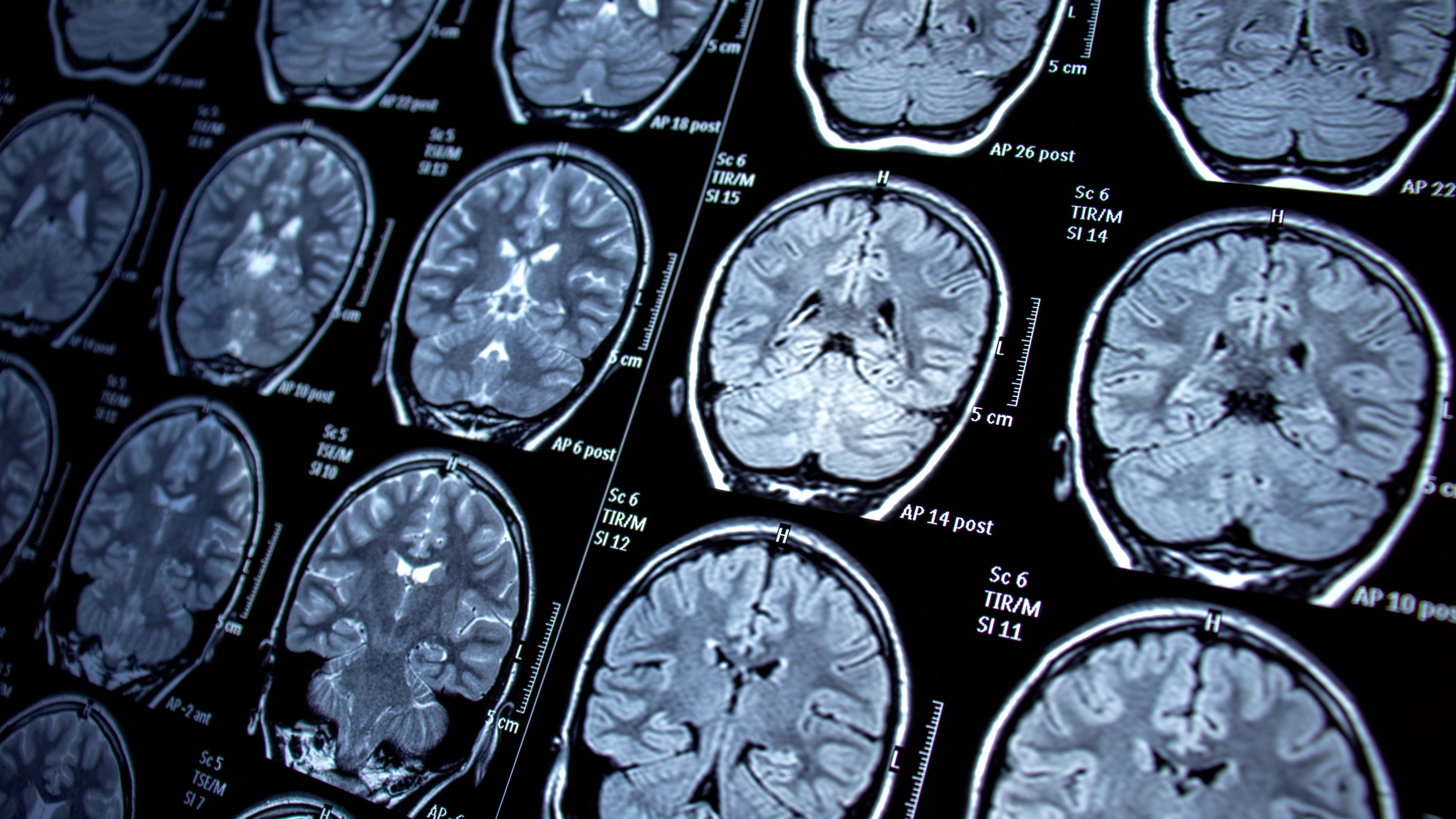 USC: Small molecule drug may prove effective in treating cancerous brain tumor