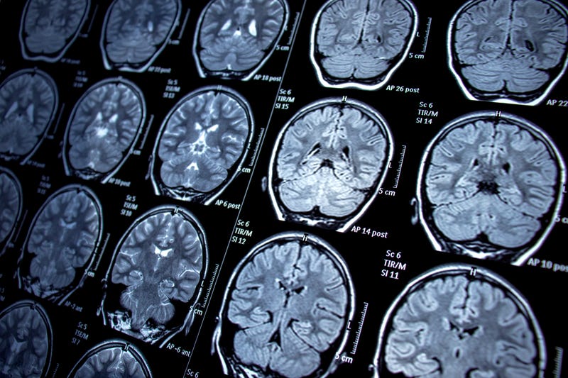 USC: Small Molecule Drug May Prove Effective in Treating Cancerous Brain Tumor