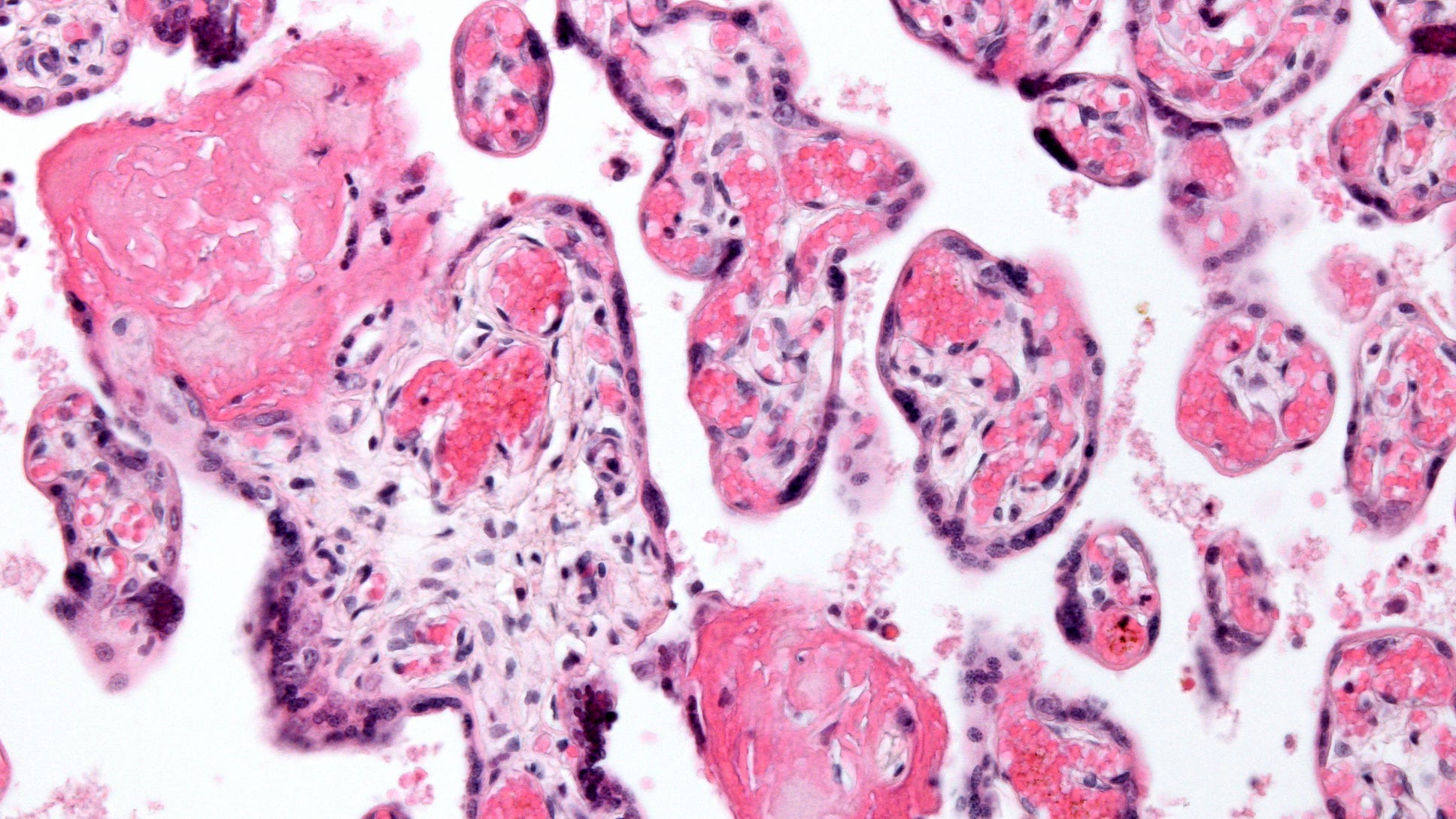 Coronavirus leads to stillbirths