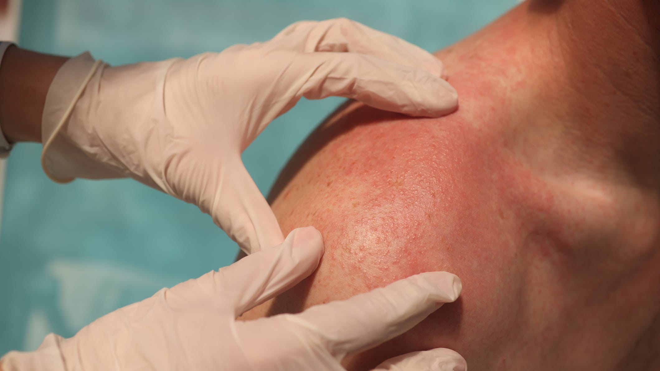 Minnesota has one of the highest rates of skin cancer in the country