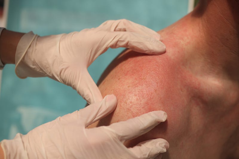 Skin Cancer