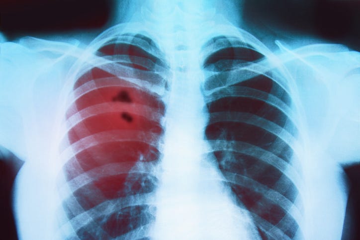 Louisiana 45th for detecting lung cancer early