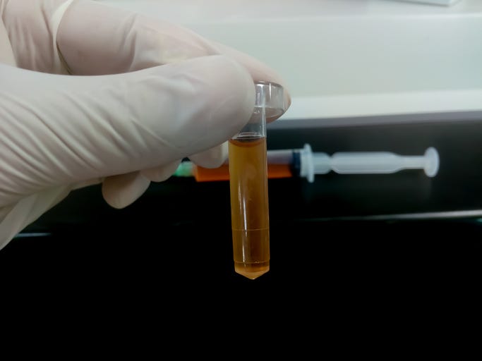 Biochemist holding a Cerebrospinal fluid (CSF) sample.