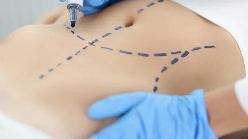 Plastic surgery is booming; here are the most popular procedures