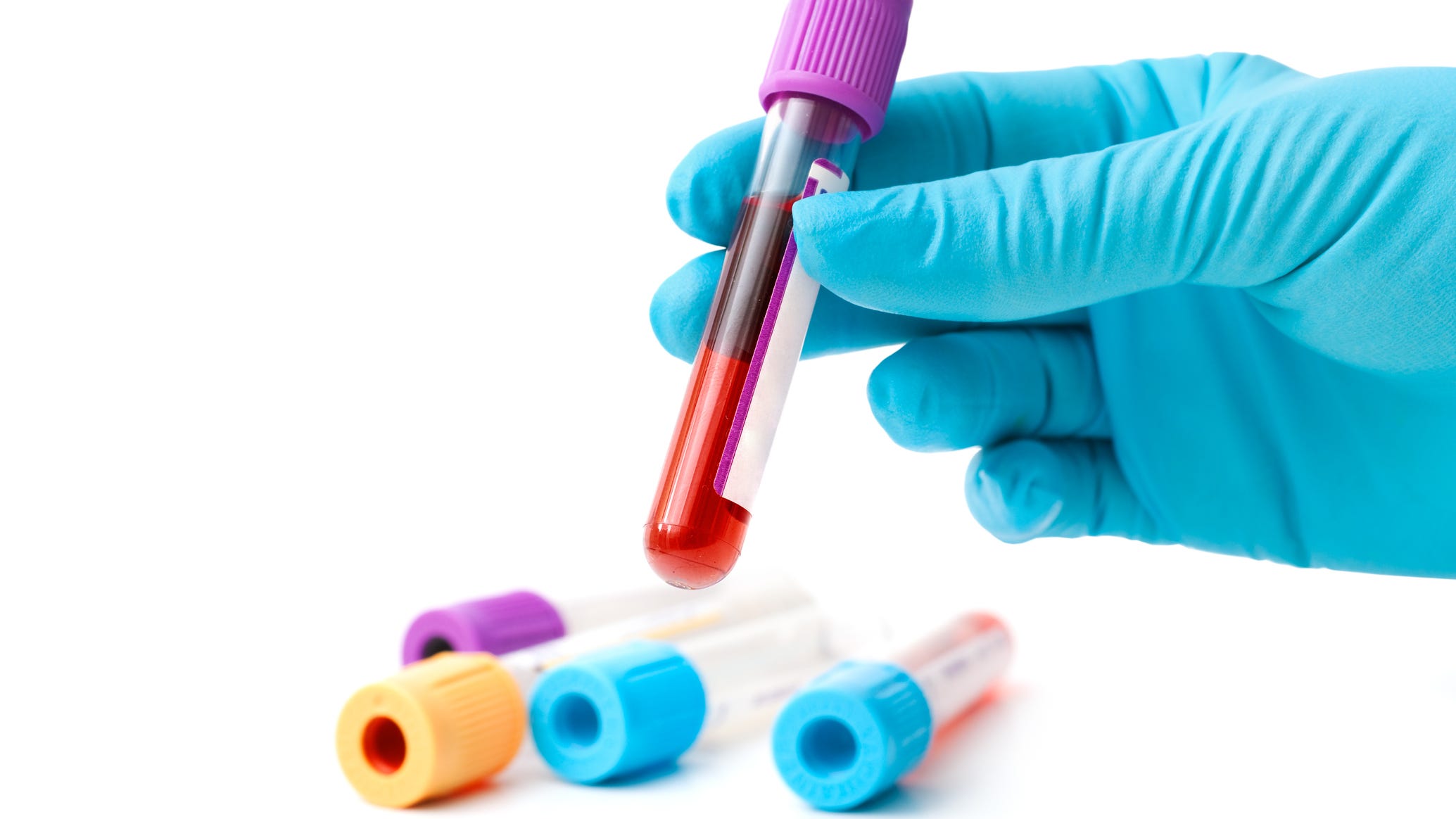 As Prescribed: New blood test could revolutionize Alzheimer’s disease diagnostics